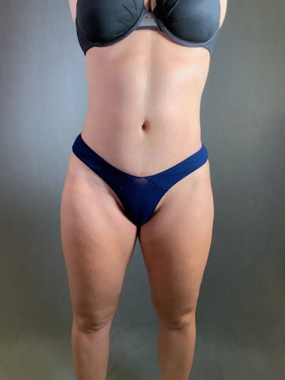 Standard Abdominoplasty Before & After Gallery - Patient 167403350 - Image 2