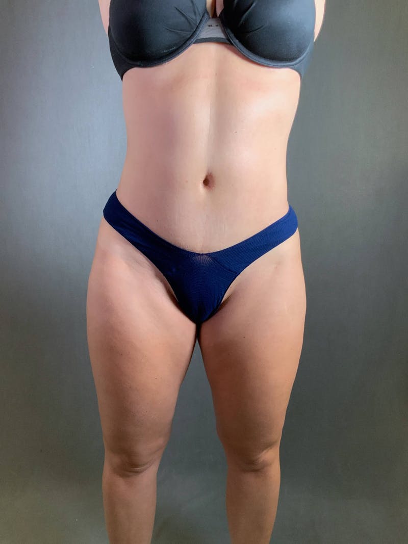 Standard Abdominoplasty Before & After Gallery - Patient 167403350 - Image 2