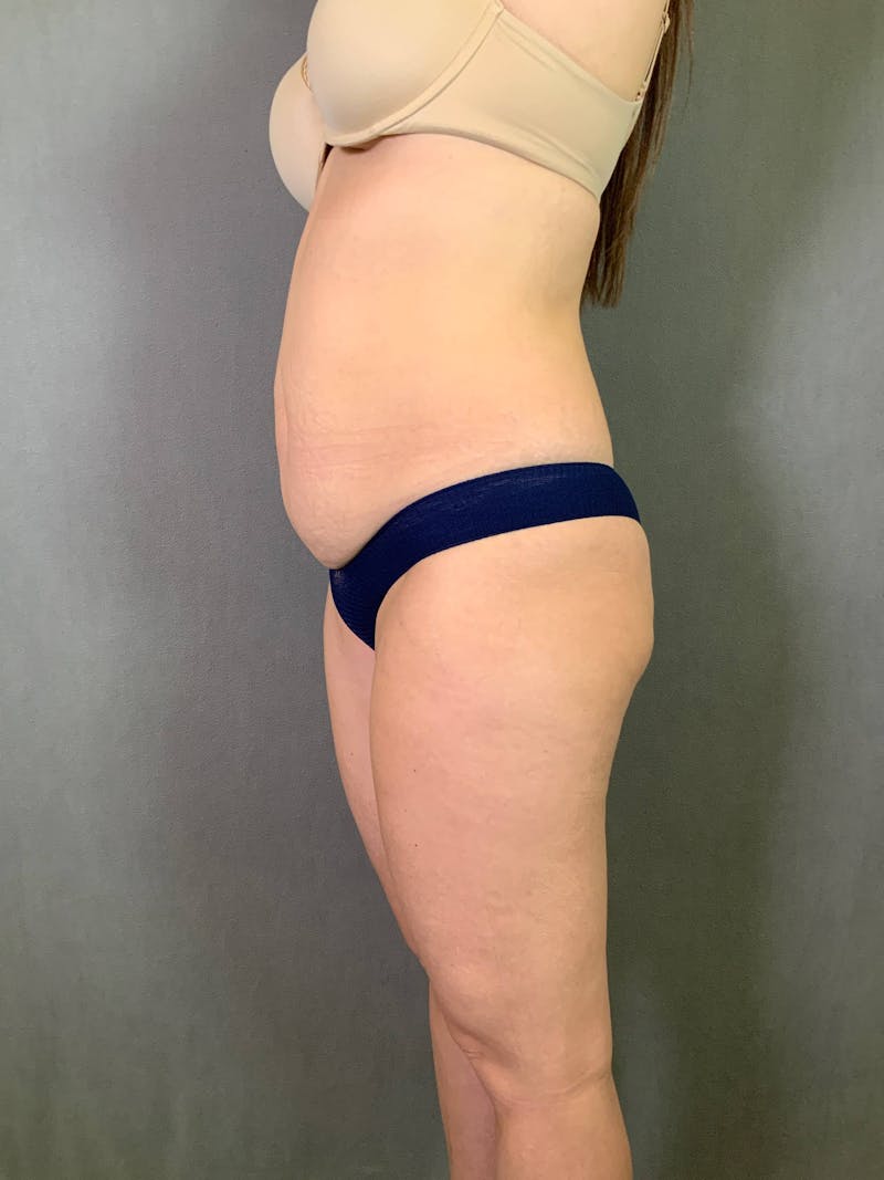 Standard Abdominoplasty Before & After Gallery - Patient 167403350 - Image 5