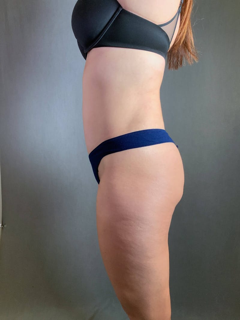 Standard Abdominoplasty Before & After Gallery - Patient 167403350 - Image 6