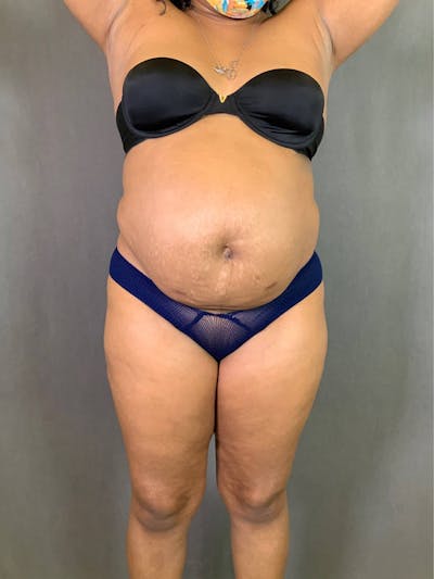 Standard Abdominoplasty Before & After Gallery - Patient 167403351 - Image 1