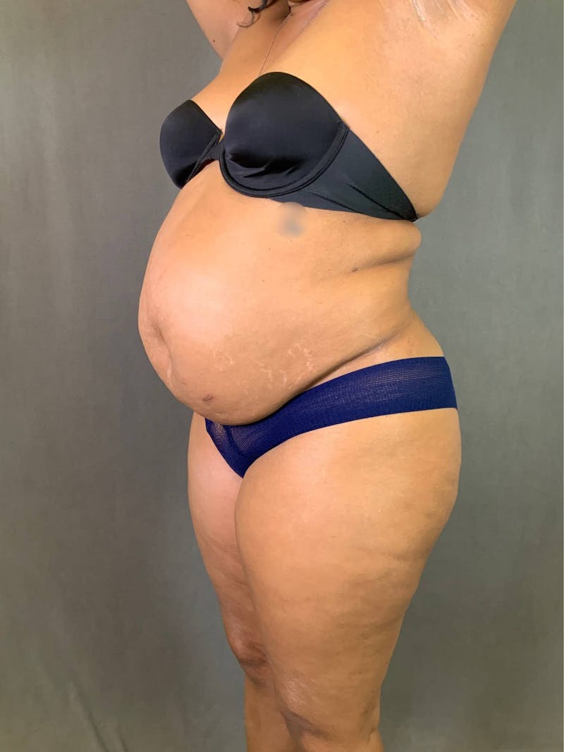 Standard Abdominoplasty Before & After Gallery - Patient 167403351 - Image 3