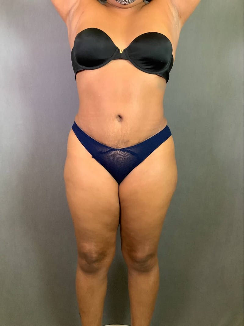 Standard Abdominoplasty Before & After Gallery - Patient 167403351 - Image 2