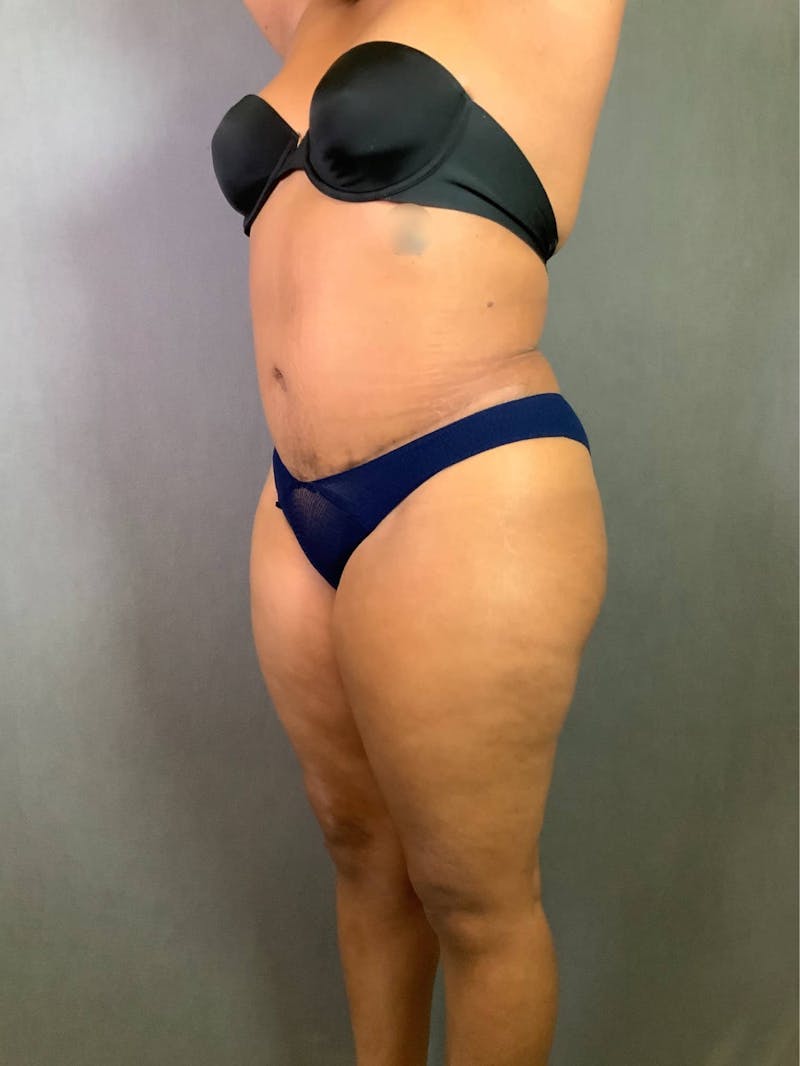 Standard Abdominoplasty Before & After Gallery - Patient 167403351 - Image 4