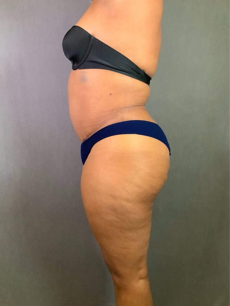 Standard Abdominoplasty Before & After Gallery - Patient 167403351 - Image 6