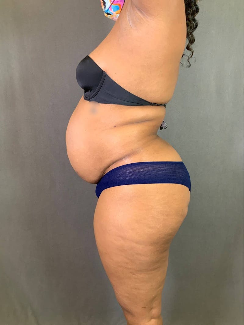 Standard Abdominoplasty Before & After Gallery - Patient 167403351 - Image 5