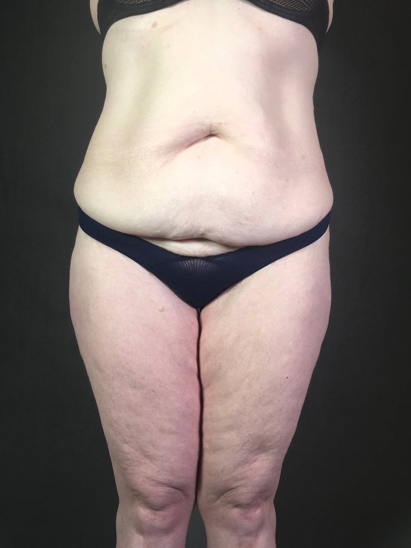 Standard Abdominoplasty Before & After Gallery - Patient 167403352 - Image 1