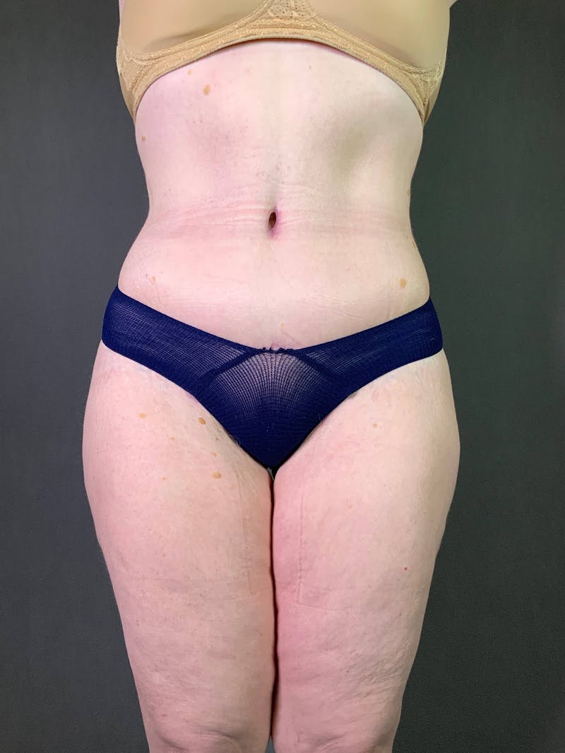 Standard Abdominoplasty Before & After Gallery - Patient 167403352 - Image 2