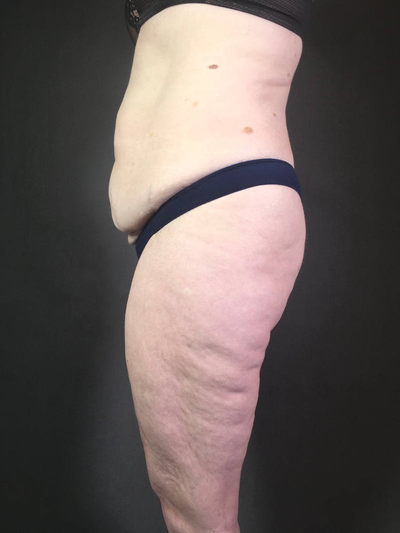 Standard Abdominoplasty Before & After Gallery - Patient 167403352 - Image 3