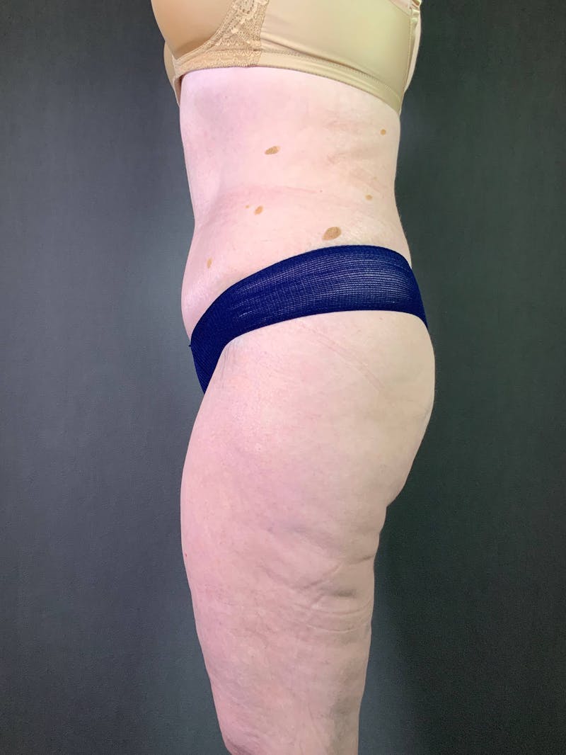 Standard Abdominoplasty Before & After Gallery - Patient 167403352 - Image 4