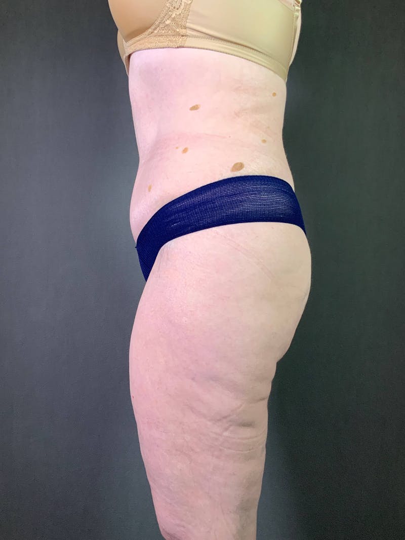 Standard Abdominoplasty Before & After Gallery - Patient 167403352 - Image 4