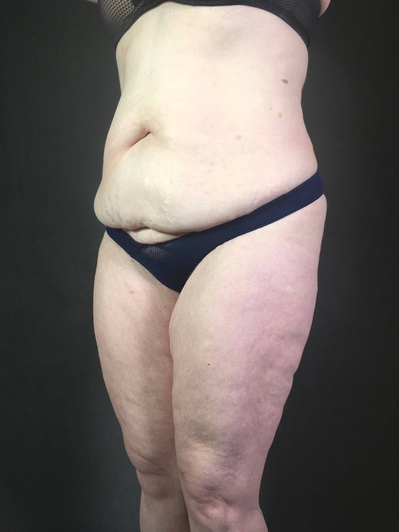 Standard Abdominoplasty Before & After Gallery - Patient 167403352 - Image 5