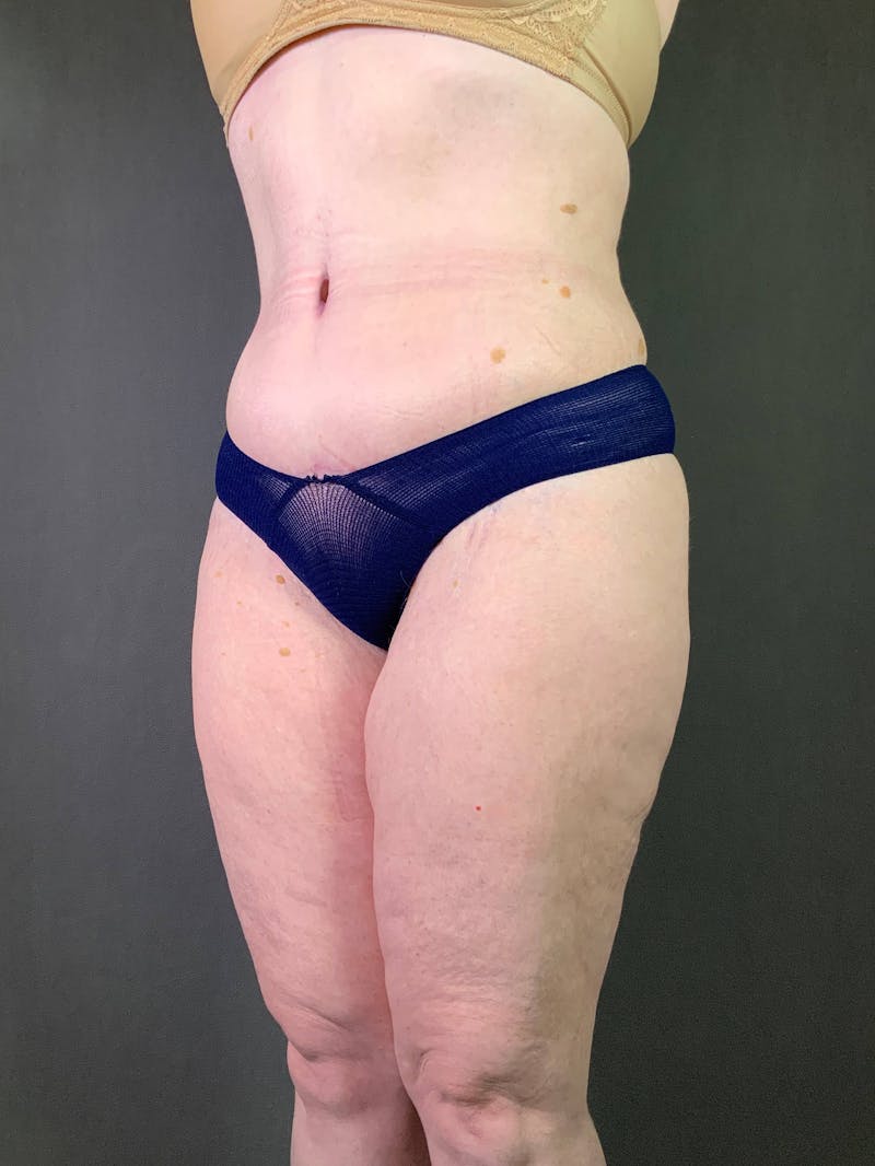 Standard Abdominoplasty Before & After Gallery - Patient 167403352 - Image 6