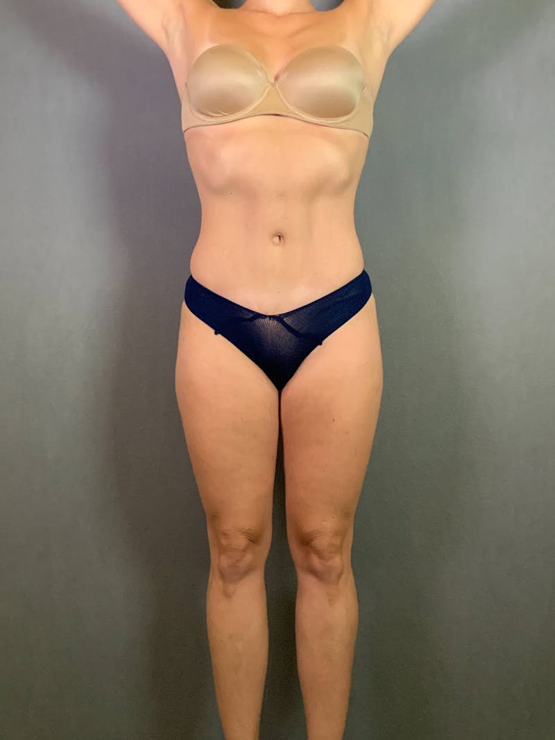 Standard Abdominoplasty Before & After Gallery - Patient 167403353 - Image 1