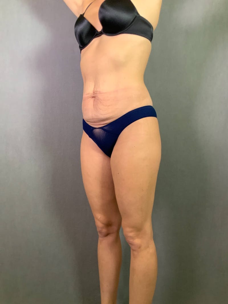 Standard Abdominoplasty Before & After Gallery - Patient 167403353 - Image 5