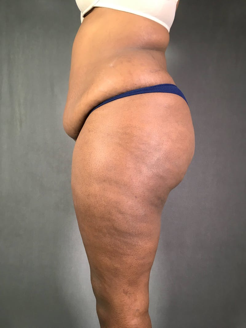 Standard Abdominoplasty Before & After Gallery - Patient 167403354 - Image 5