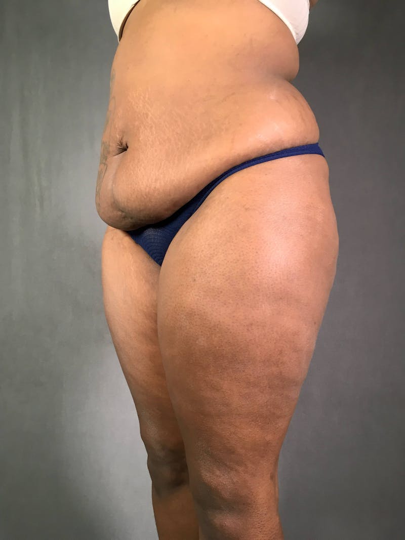 Standard Abdominoplasty Before & After Gallery - Patient 167403354 - Image 3