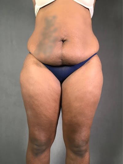 Standard Abdominoplasty Before & After Gallery - Patient 167403354 - Image 1