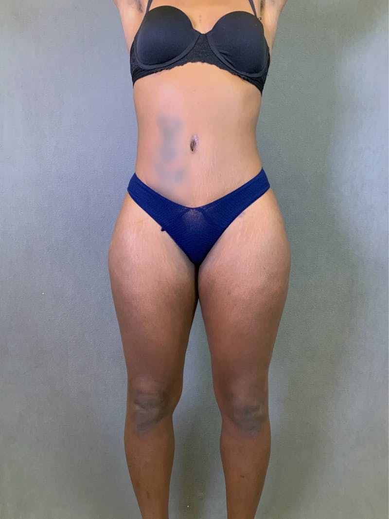 Standard Abdominoplasty Before & After Gallery - Patient 167403354 - Image 2