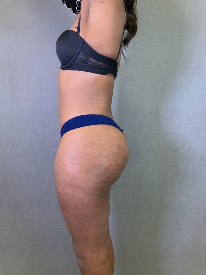 Standard Abdominoplasty Before & After Gallery - Patient 167403354 - Image 6