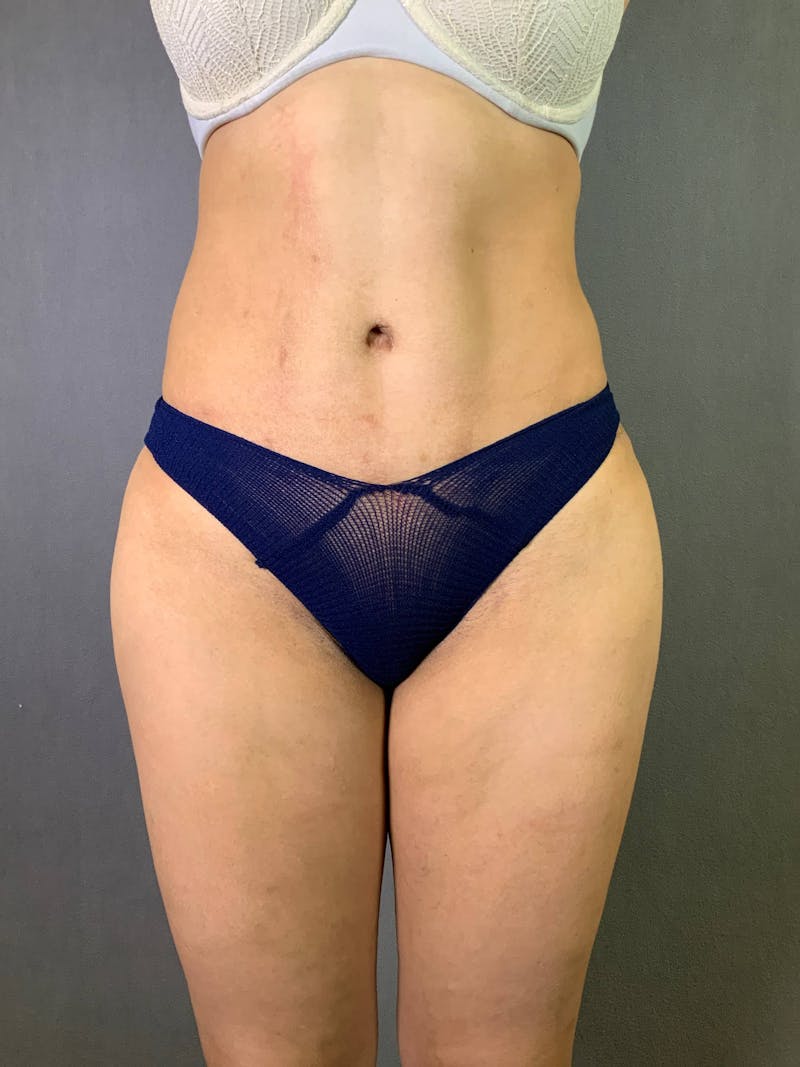 Standard Abdominoplasty Before & After Gallery - Patient 167403355 - Image 2