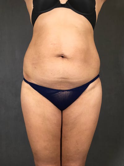 Standard Abdominoplasty Before & After Gallery - Patient 167403355 - Image 1