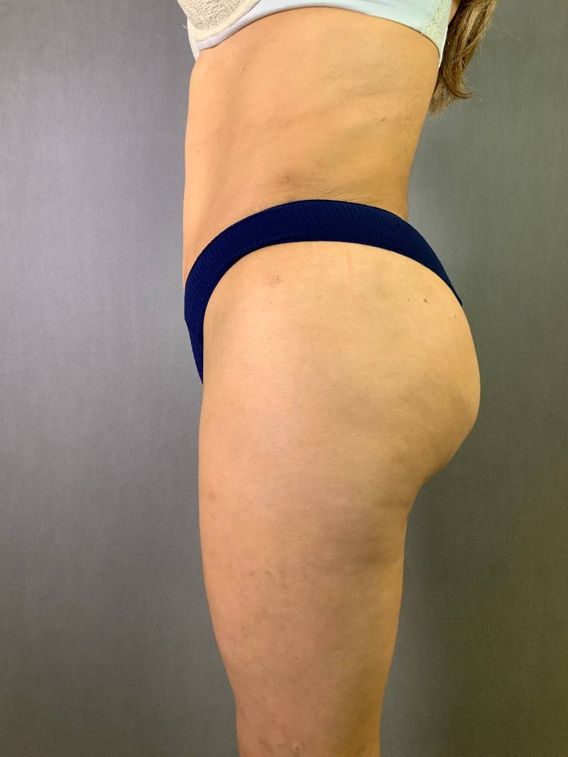 Standard Abdominoplasty Before & After Gallery - Patient 167403355 - Image 6