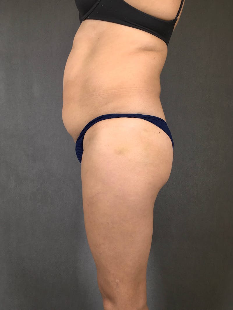 Brazilian Butt Lift Before & After Gallery - Patient 167408781 - Image 4