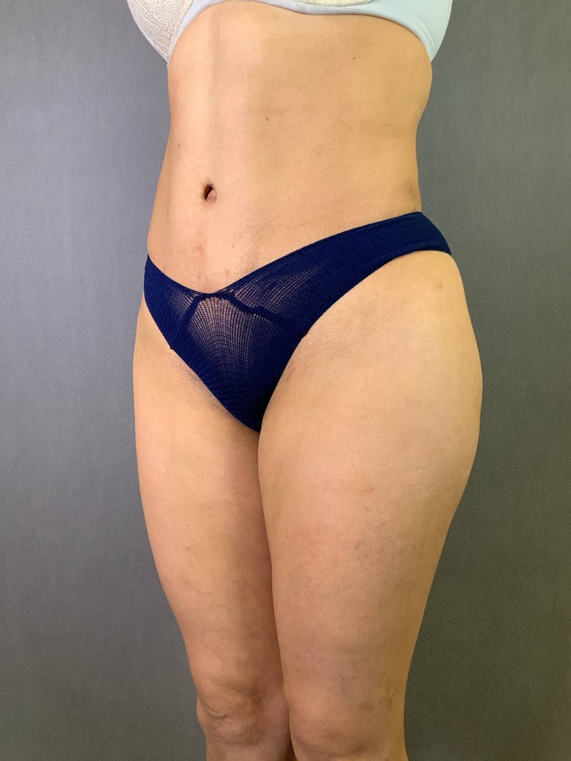 Standard Abdominoplasty Before & After Gallery - Patient 167403355 - Image 4
