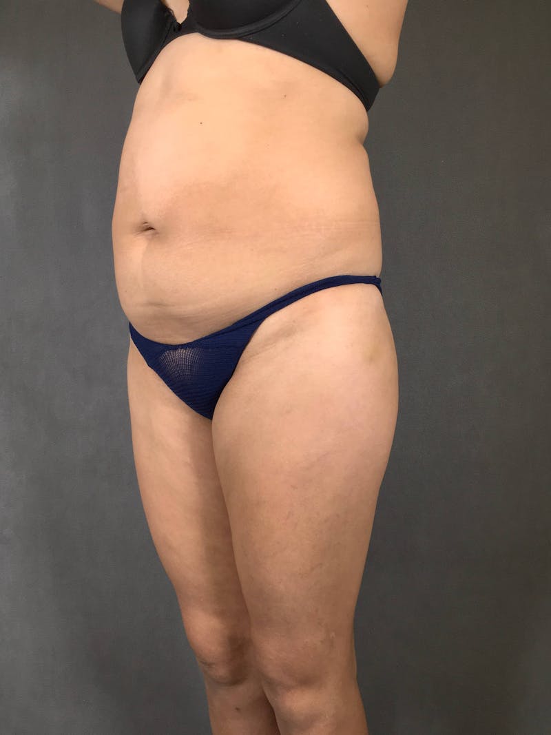 Standard Abdominoplasty Before & After Gallery - Patient 167403355 - Image 3