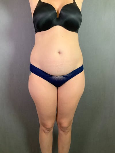 Standard Abdominoplasty Before & After Gallery - Patient 167403361 - Image 1