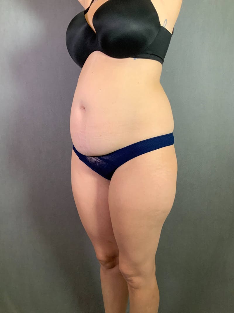 Standard Abdominoplasty Before & After Gallery - Patient 167403361 - Image 3
