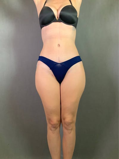 Standard Abdominoplasty Before & After Gallery - Patient 167403361 - Image 2