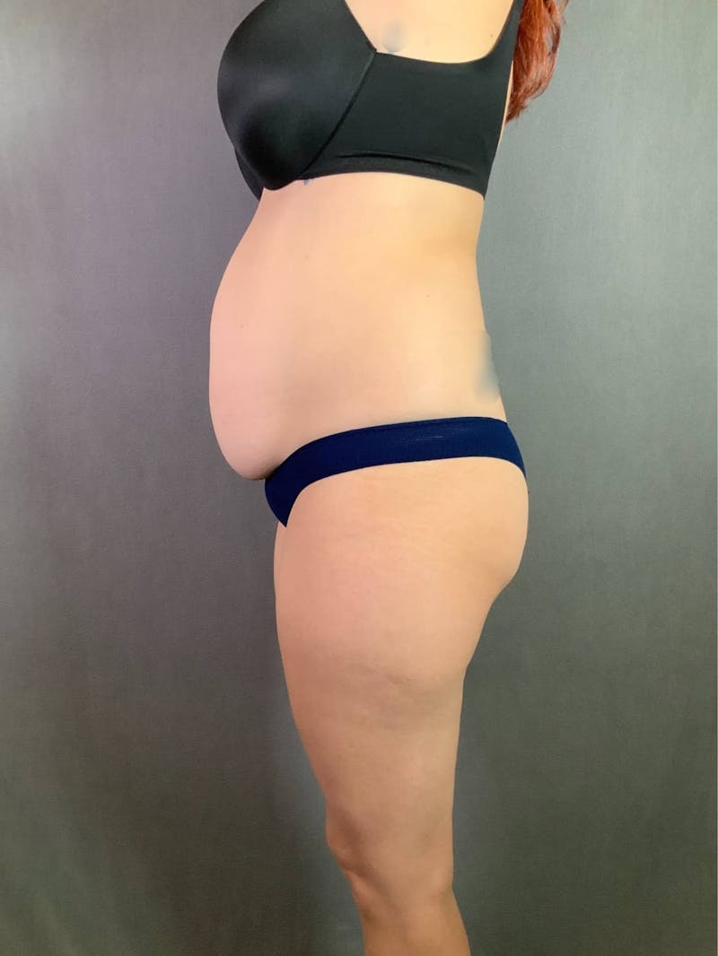Standard Abdominoplasty Before & After Gallery - Patient 167403361 - Image 5
