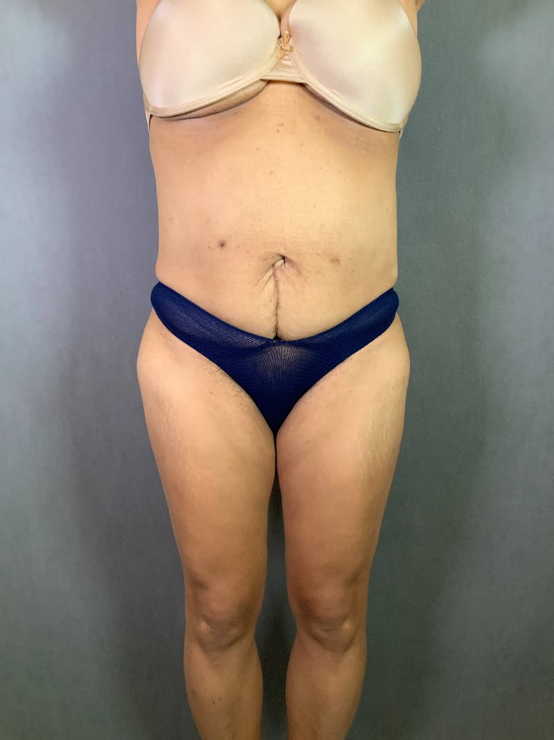 Standard Abdominoplasty Before & After Gallery - Patient 167403362 - Image 1