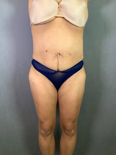 Standard Abdominoplasty Before & After Gallery - Patient 167403362 - Image 1