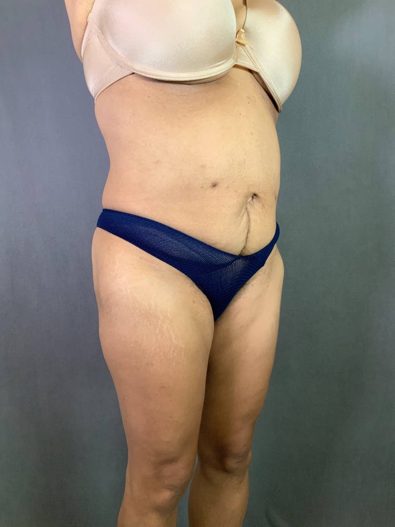 Standard Abdominoplasty Before & After Gallery - Patient 167403362 - Image 3