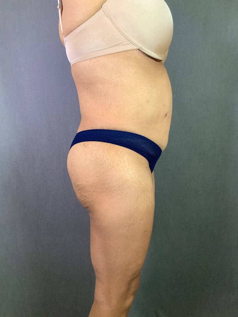 Standard Abdominoplasty Before & After Gallery - Patient 167403362 - Image 5