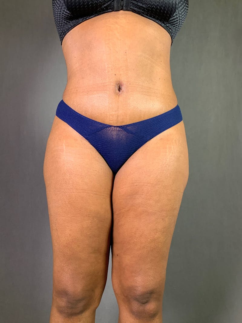 Standard Abdominoplasty Before & After Gallery - Patient 167408666 - Image 2