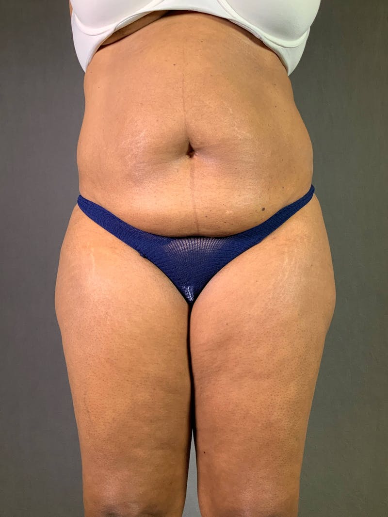 Standard Abdominoplasty Before & After Gallery - Patient 167408666 - Image 1