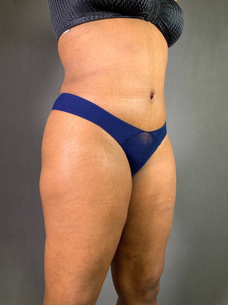 Standard Abdominoplasty Before & After Gallery - Patient 167408666 - Image 4