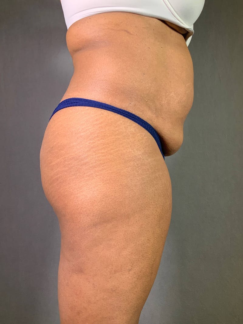Standard Abdominoplasty Before & After Gallery - Patient 167408666 - Image 5