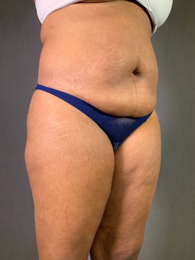 Standard Abdominoplasty Before & After Gallery - Patient 167408666 - Image 3