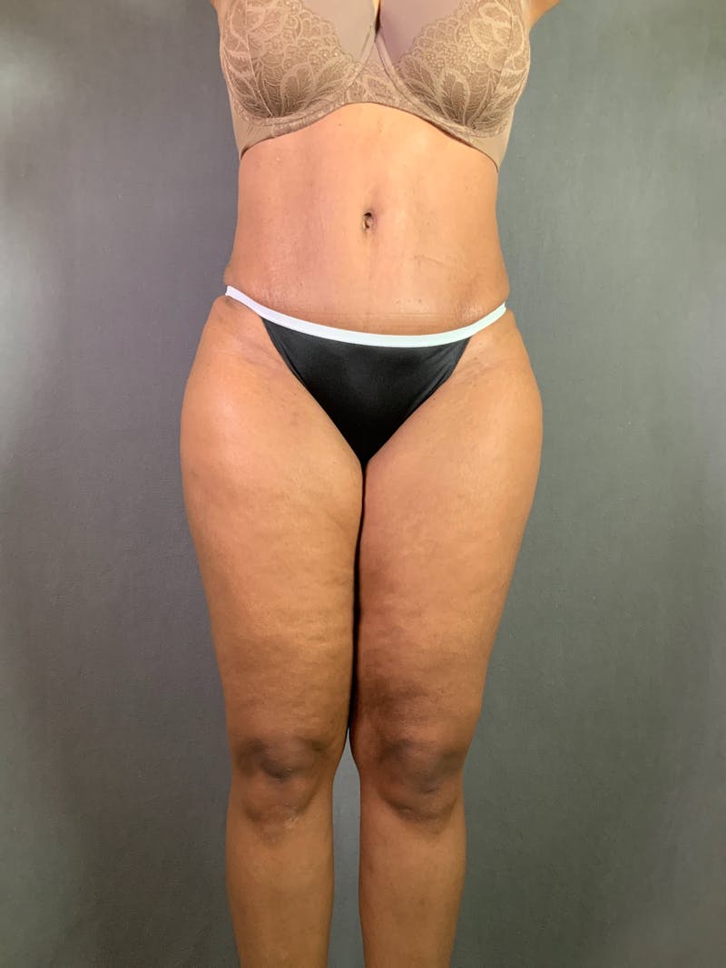 Standard Abdominoplasty Before & After Gallery - Patient 167408677 - Image 2