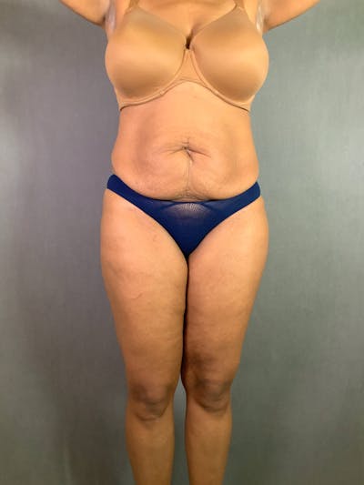 Standard Abdominoplasty Before & After Gallery - Patient 167408677 - Image 1