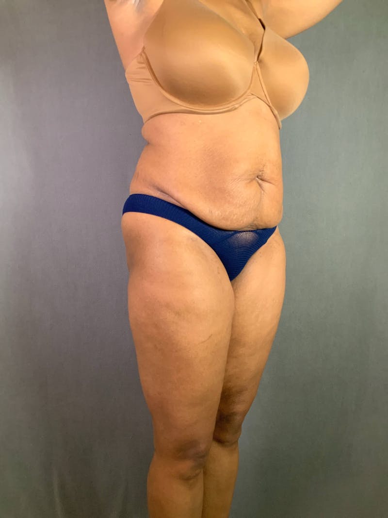 Standard Abdominoplasty Before & After Gallery - Patient 167408677 - Image 3