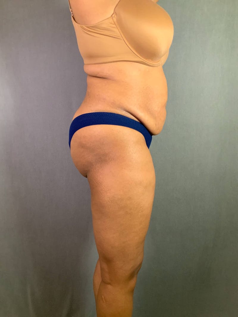 Standard Abdominoplasty Before & After Gallery - Patient 167408677 - Image 5