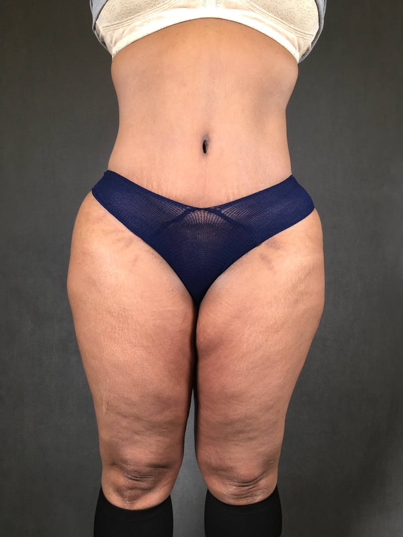 Standard Abdominoplasty Before & After Gallery - Patient 167408678 - Image 2