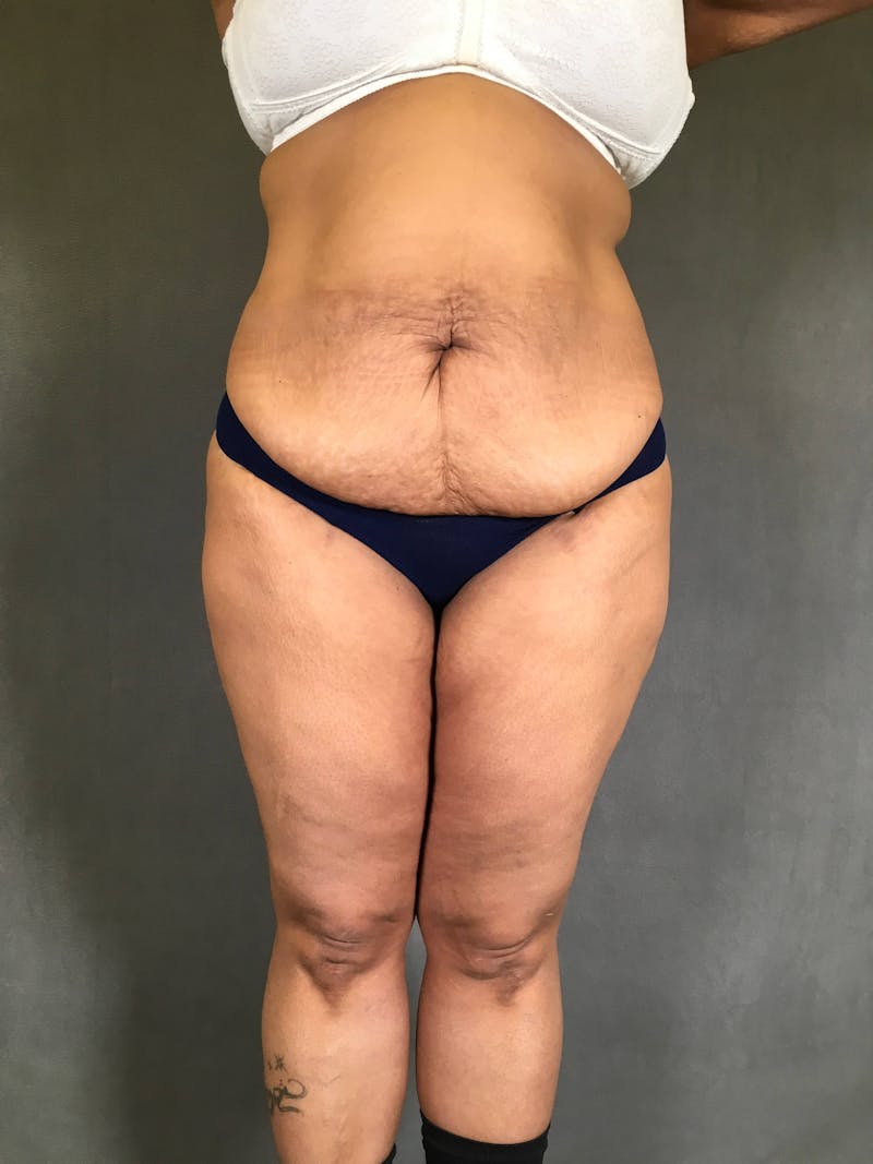 Standard Abdominoplasty Before & After Gallery - Patient 167408678 - Image 1
