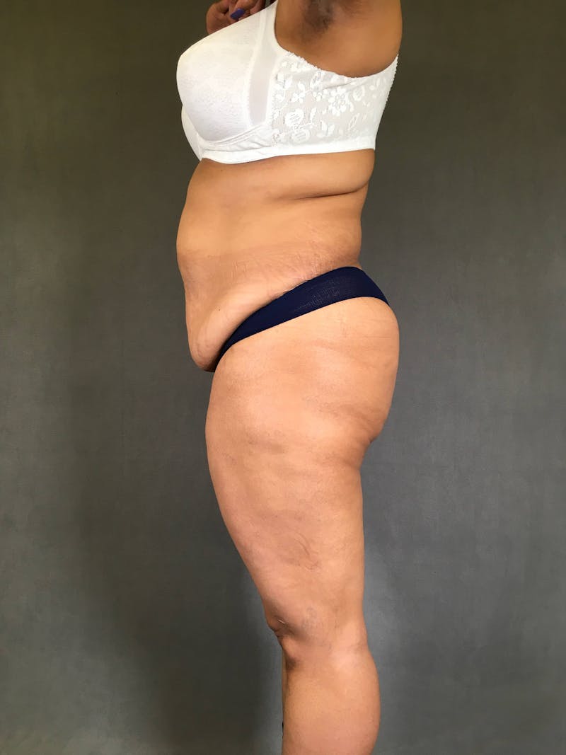Standard Abdominoplasty Before & After Gallery - Patient 167408678 - Image 5